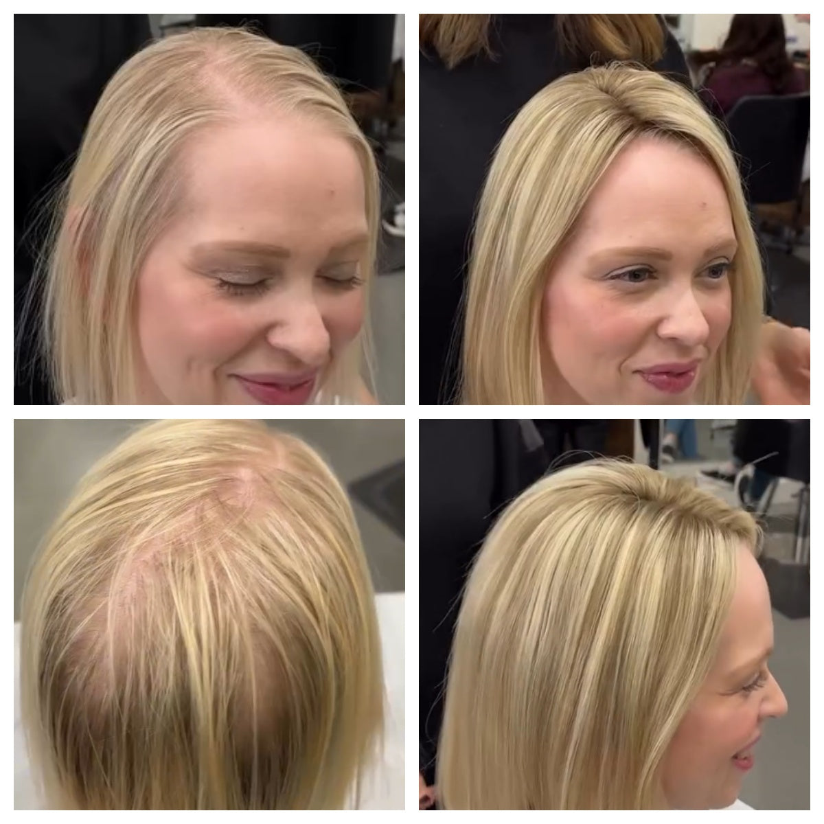 Best Hair Toppers for Thinning Hair and Hair Loss Women