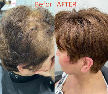 2025 New Summer Breathable&comfortable Short Hair Topper For Thinning Hair
